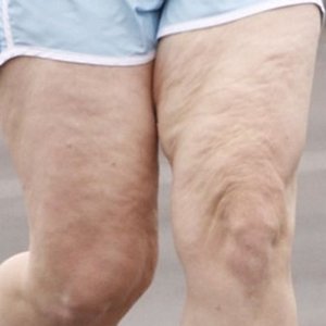 Jak szybko i skutecznie zwalczyć cellulit?