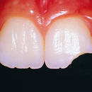 Co zrobić, gdy w czasie pobytu na wakacjach ukruszy ci się ząb?