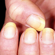 W jaki sposób wybielić żółte paznokcie?