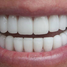 Jak skutecznie wybielić zęby?