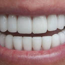 Jak skutecznie wybielić zęby?