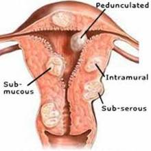 Jakie są objawy mięśniaków macicy i jak je leczyć?