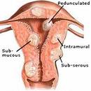Jakie są objawy mięśniaków macicy i jak je leczyć?