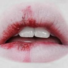 W jaki sposób leczyć zajady?