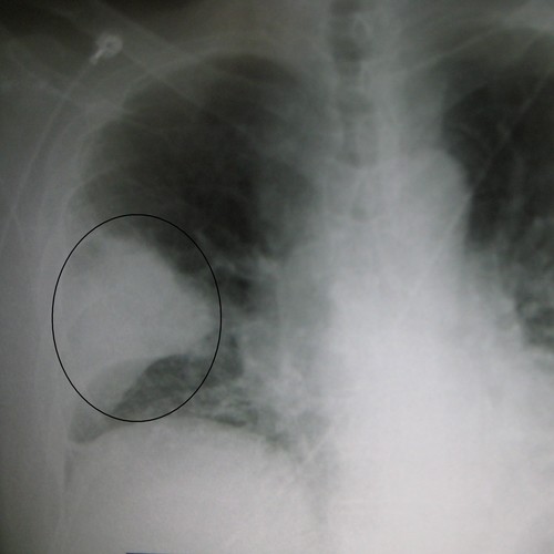 Objawy oraz leczenie zapalenia płuc