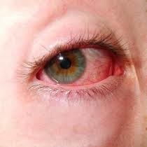 Objawy zapalenia spojówek