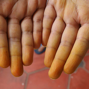 Usuwanie plam ze skóry