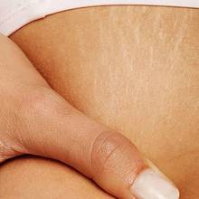 Skuteczne metody na rozstępy