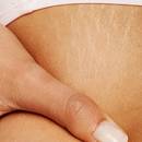 Skuteczne metody na rozstępy