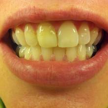 Skuteczne usuwanie przebarwień na zębach