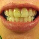 Skuteczne usuwanie przebarwień na zębach