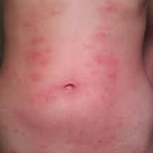 Jak rozpoznać, co to za wysypka?