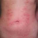 Jak rozpoznać, co to za wysypka?