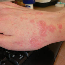 Domowe sposoby na świerzb