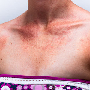 Przyczyny alergii słonecznej