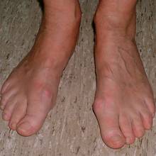 W jaki sposób leczyć haluksy?