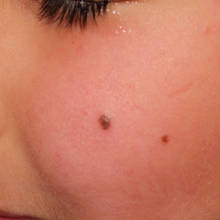 Sposób na pozbycie się pieprzyków przy użyciu olejku oregano