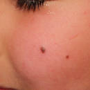 Sposób na pozbycie się pieprzyków przy użyciu olejku oregano