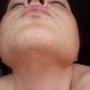 Jakie są sposoby leczenia nadmiernego owłosienia?