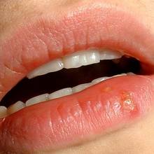 Domowe sposoby na opryszczkę