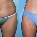 Jak trwale pozbyć się cellulitu?