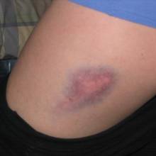 W jaki sposób leczyć krwiaki?