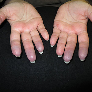 Przyczyny zimnych dłoni i stóp