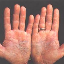 Gdzie pojawia się łuszczyca?