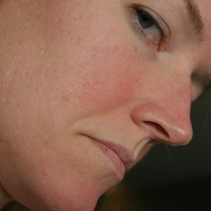 Przyczyny rozszerzonych porów