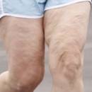 Jak szybko i skutecznie zwalczyć cellulit?