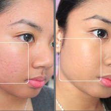 W jaki sposób zlikwidować przebarwienia skóry?