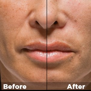 Mezoterapia bezigłowa