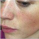 Domowe sposoby na zatkane pory