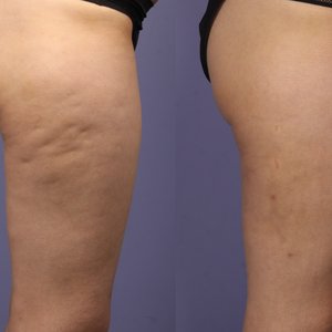 Jak zwalczyć cellulit naturalnymi sposobami