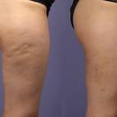 Jak zwalczyć cellulit naturalnymi sposobami