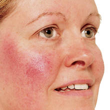 Naturalne sposoby na trądzik różowaty