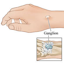 Jak postępować z ganglionem?