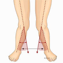 Jak radzić sobie z koślawymi kolanami?
