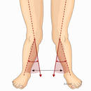 Jak radzić sobie z koślawymi kolanami?