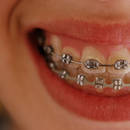 Zasady dbania o zęby z aparatem ortodontycznym