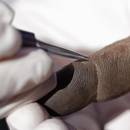 Jak wyjąć drzazgę?