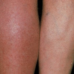 Leczenie nadczynności tarczycy