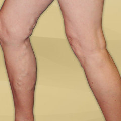 Zagrożenie pojawieniem się żylaków