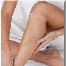 Domowe sposoby leczenia żylaków i obrzęków nóg