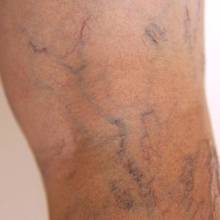 Sposoby na poradzenie sobie z żylakami