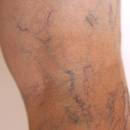 Sposoby na poradzenie sobie z żylakami