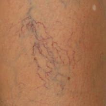 Jak walczyć z pajączkami na nogach?