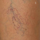 Jak walczyć z pajączkami na nogach?