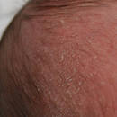 Leczenie ciemieniuchy – porady i wskazówki