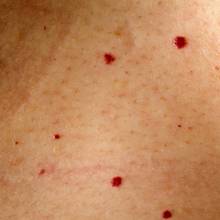 Jak skutecznie walczyć z pajączkami na skórze?